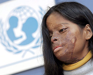 La joven Hasina Akter, víctima de un ataque con ácido a los 17 años. (Foto: EFE)