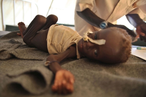 Un niño desnutrido en una clínica de MSF para refugiados en Jamam | AFP