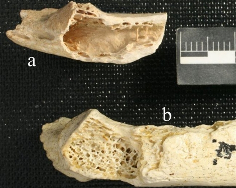 Restos óseos del Neanderthal de hace 120.000 años con cáncer. | PLOS ONE