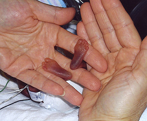Los pies de la peque&ntilde;a Amillia Taylor. (Fotos: AFP | Baptist Children's Hospital)