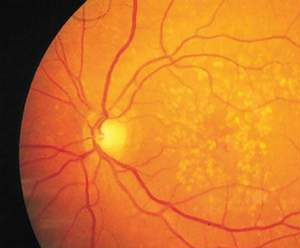 Imagen por angiografía de un ojo con degeneración macular (Foto: NEI) Imagen por angiografía de un ojo con degeneración macular (Foto: NEI)