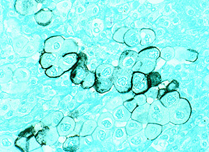 Células tumorales de un cáncer de páncreas (Foto: NCI)