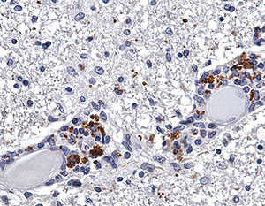 Los 'lunares' marrones muestran la angiotensina en una lesi&oacute;n cerebral de un paciente con esclerosis (Foto: L. Steinman)