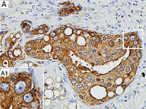 Células en un tumor maligno de próstata (de color marrón), infectadas por el virus. (Foto: PNAS)