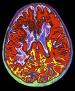 Cerebro con esclerosis múltiple. (Imagen: El Mundo)