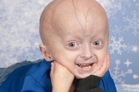 Un niño de cuatro años con progeria. | Fundación para la Investigación de la Progeria