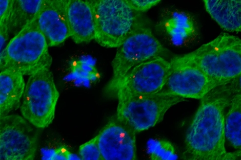 Imagen de células tumorales al microscopio.| Reuters